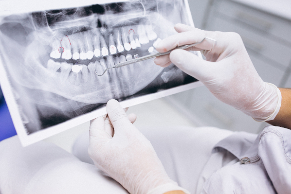 Błędnie wykonany aparat nakładkowy Invisalign — rodzaj aparatu ortodontycznego na zęby