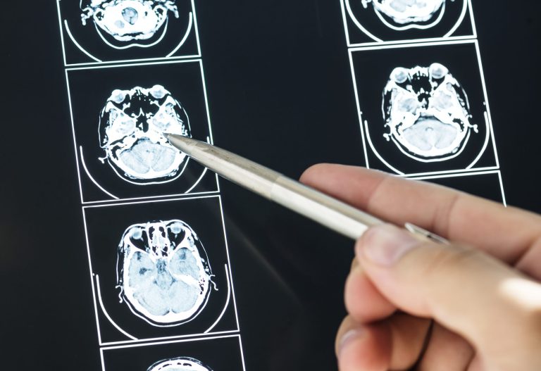 Nierozpoznany udar mózgu na SOR – kiedy opóźniona diagnoza jest błędem medycznym?